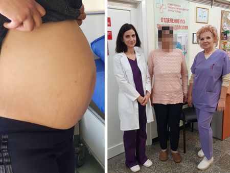Екип на отделението по онкогинекология към КОЦ-Бургас отстрани успешно 8-килограмов тумор от матката на 36-годишна жена