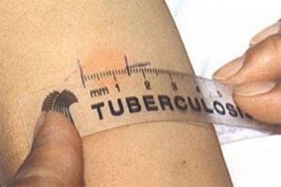 Белодробната болница в Бургас прави прегледи за туберкулоза