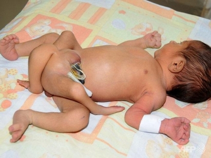 В Пакистан се роди бебе с шест крака