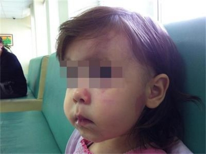 Момиченце на 1 годинка и 10 месеца жестоко пребито в яслата