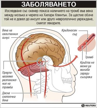 Хилари Клинтън има рак на мозъка?