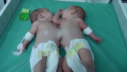 Лекари от Алтай разделиха сиамски близнаци