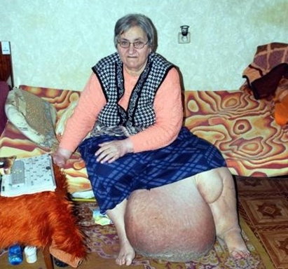 Жена със "слонски" крак: Още храня надежда за помощ