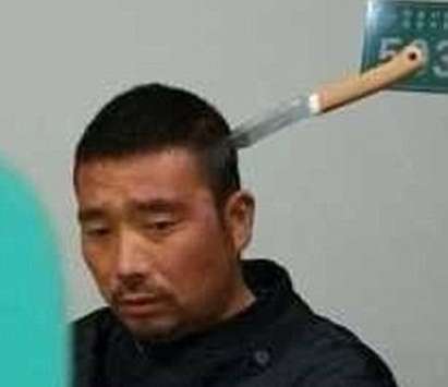 Китаец с нож, забит в главата му, влезе в болница, лекарите в шок