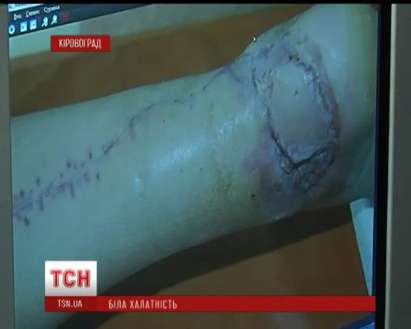Краката на пациентка изгоряха по време на операция заради небрежни лекари (ВИДЕО)