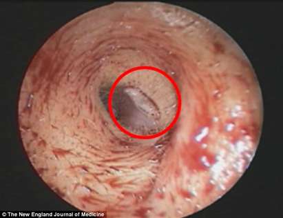 Ухо на жена се възпали заради личинка на муха