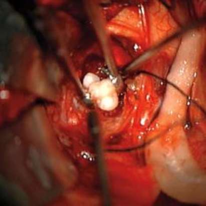 В мозъка на бебе расте зъб, хирурзи му го извадиха
