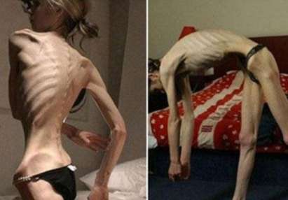 Поредната жертва на анорексията! 20-годишна красавица се превърна в мумия