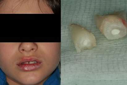 Проблемно дете изби зъбите на петокласник в училище