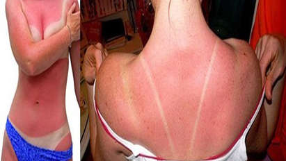 Слънцезащитните кремове предпазват само наполовина, вижте какво става с кожата ни /ВИДЕО/