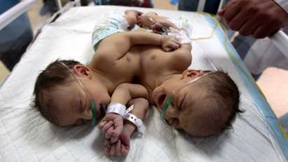 Уникално: Хиляди прииждат в болница да видят бебе с 2 глави