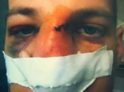 Коцето за мелето в Студентски град: "Невинният" Кирил вкара носа на едно момче в окото му
