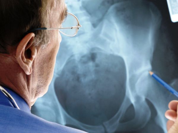 В МБАЛ – Поморие ще се проведе скринингова кампания за превенция на остеопорозата