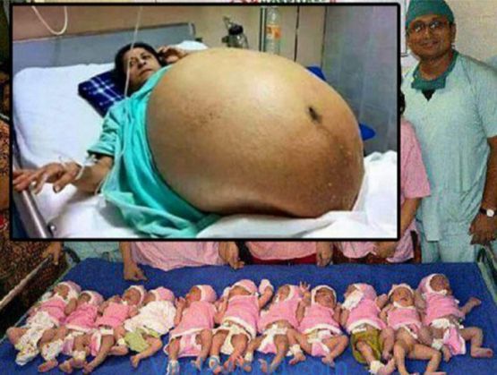 Чудо! 42-годишна жена роди 11 деца за 37 минути