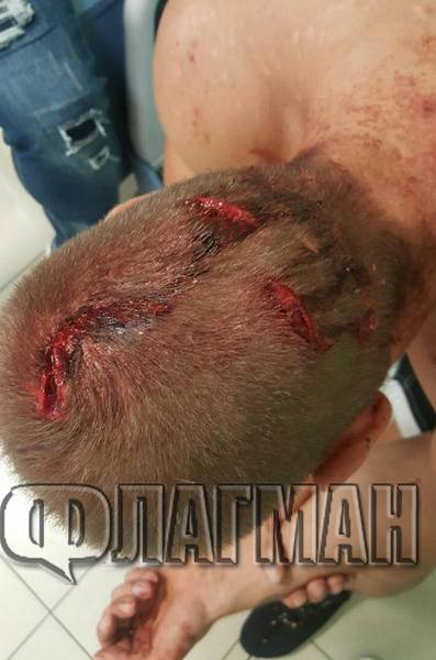  Вижте раните на млатения с секира по главата бургазлия, това лека телесна щета ли е? (СНИМКИ +18) 