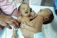Държавата отписа сиамските близнаци от Сливен