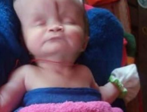 Медицинско чудо! Бебе с половин череп все още е живо, изумява лекарите (СНИМКИ 18+)