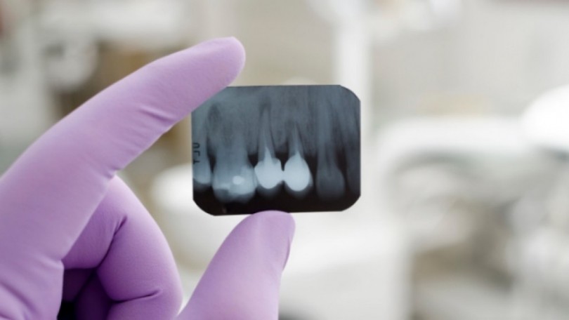 Снимка на зъба отключва рак на щитовидната жлеза