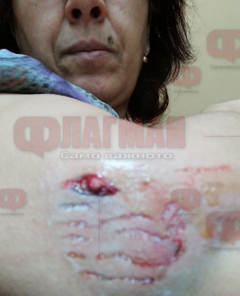 Само във Флагман.бг: Бесен ротвайлер нахапа жестоко бургазлийка в Борисовата градинка