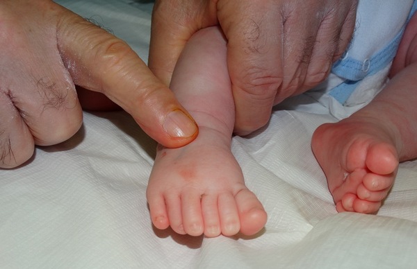 Бебе с шест пръста на всеки крайник оперирано успешно в УМБАЛ „Дева Мария“