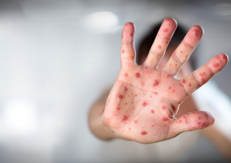 Броят на заразените от морбили в Бургас расте. Има ли опасност от епидемия? 