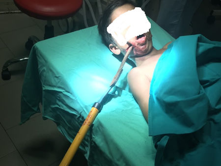 Дете от Айтос падна върху 70-сантиметрова ножица, заби се в главата му, лекари от УМБАЛ-Бургас го спасиха