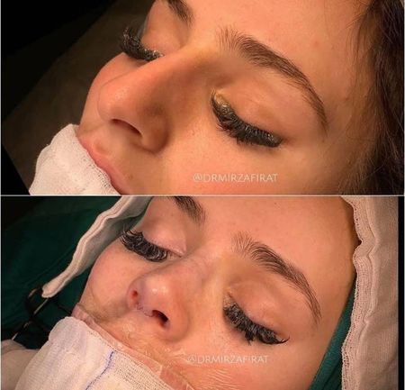 Вижте как оперират носа на Преслава