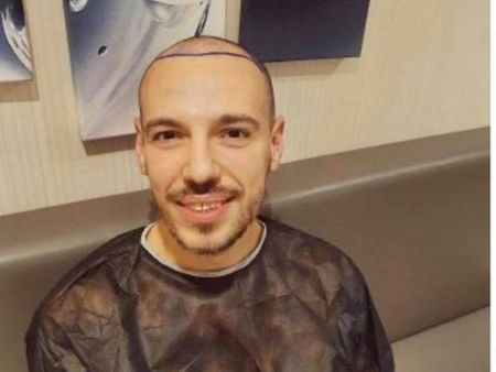 Дани Петканов си присади коса в Турция