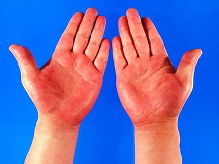 Червените длани могат да бъдат признак за опасно заболяване