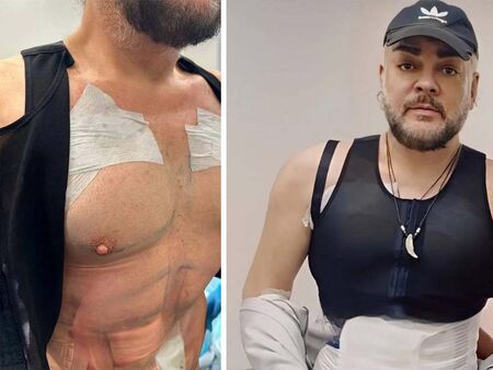Филип Киркоров се подложи на нова процедура – имплантира си плочки на корема