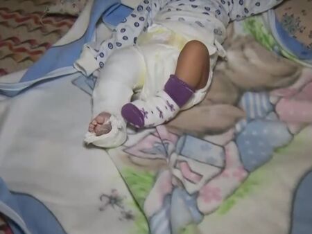 Новородено изписано от болница със счупен крак след лечение на жълтеница