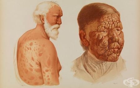 5 страшни болести от XIX век, които се завръщат