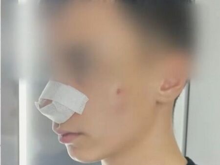 Пореден случай на насилие между деца: 13-годишен е със счупен нос и комоцио след побой
