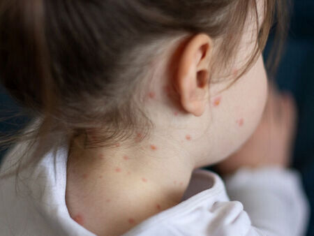 Развита страна пламна с дребна шарка