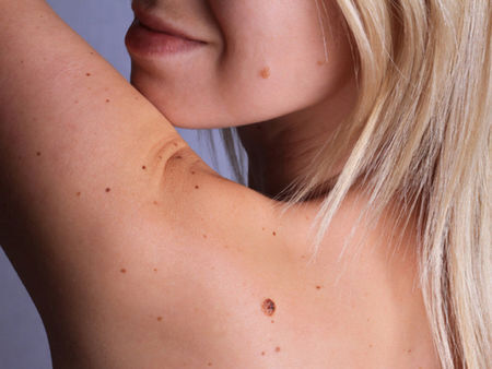 Огледайте бенките си и ако видите това, за лекар сте