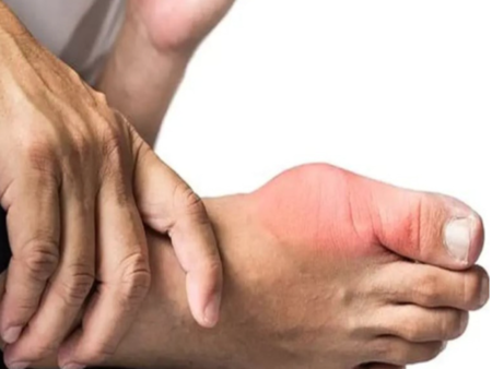 Народни средства срещу подагра