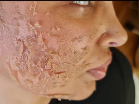 Опасна процедура за лице съсипа млада жена, прати я в болница с втора степен изгаряне