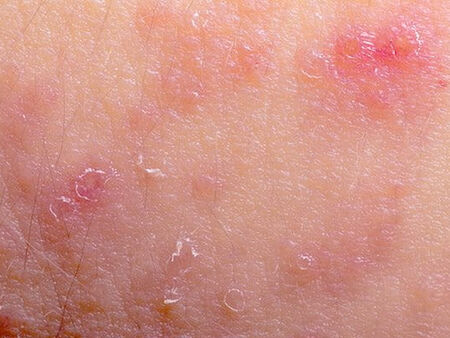 Внимание! Имате екзема, не се доближавайте до тези химикали