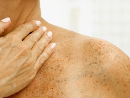 Откриха нов крем борещ се срещу рак на кожата в ранни изследвания