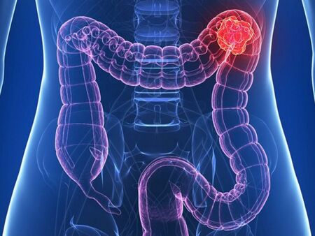Световният ден за борба с рака на дебелото черво насочва вниманието към профилактиката