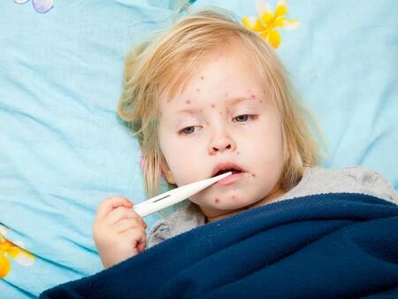 Случаите на морбили растат, огнища вече има в 6 населени места