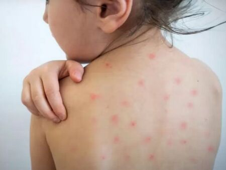 Случаите на морбили в България нараснаха до 101