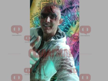 Цветомир се щракна с дълбока рана на главата, щастлив е, че е оцелял след каскадата с Роудстъра на ул. "Гурко"