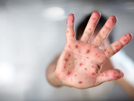 Нови случаи на морбили у нас