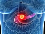 FDA одобри лекарство за рак на панкреаса, почти удвоява преживяемостта